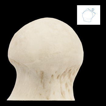 Femoral Head